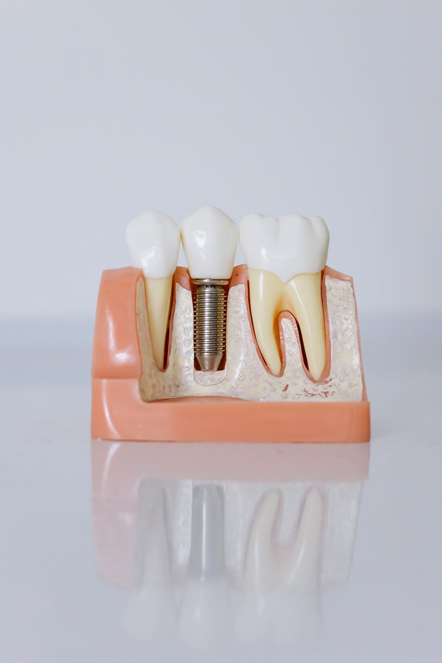 implantát zubu